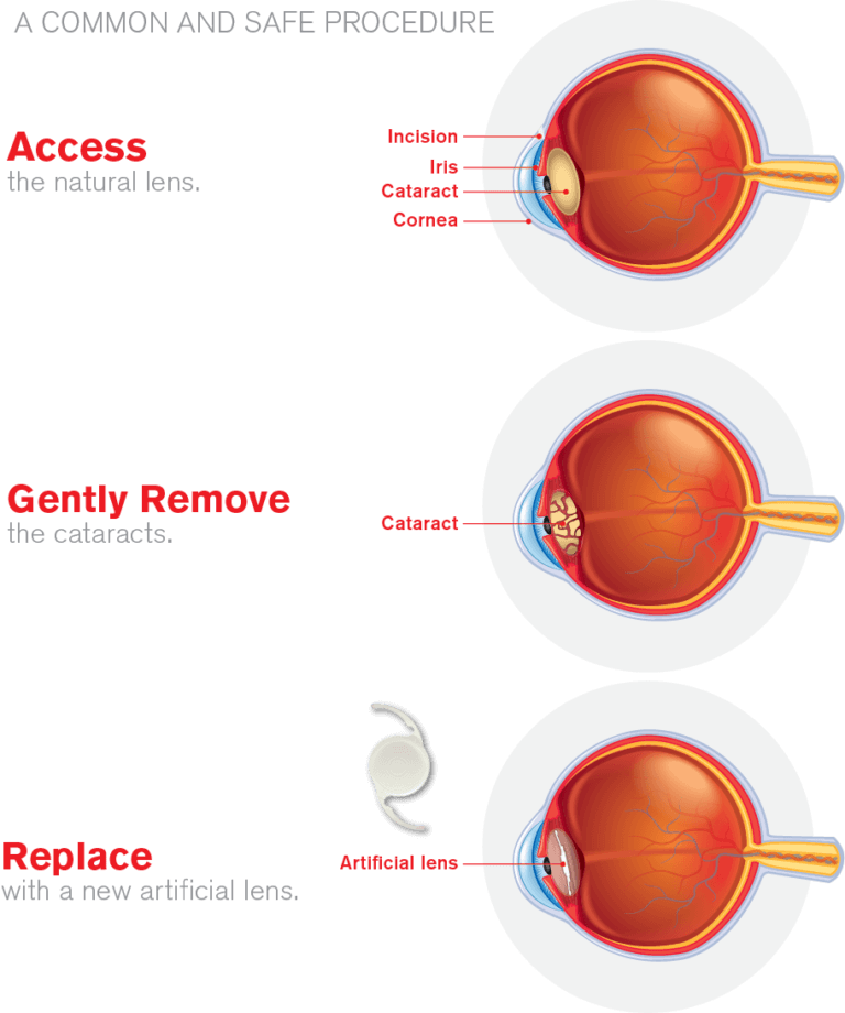 Cataract surgery process illustration