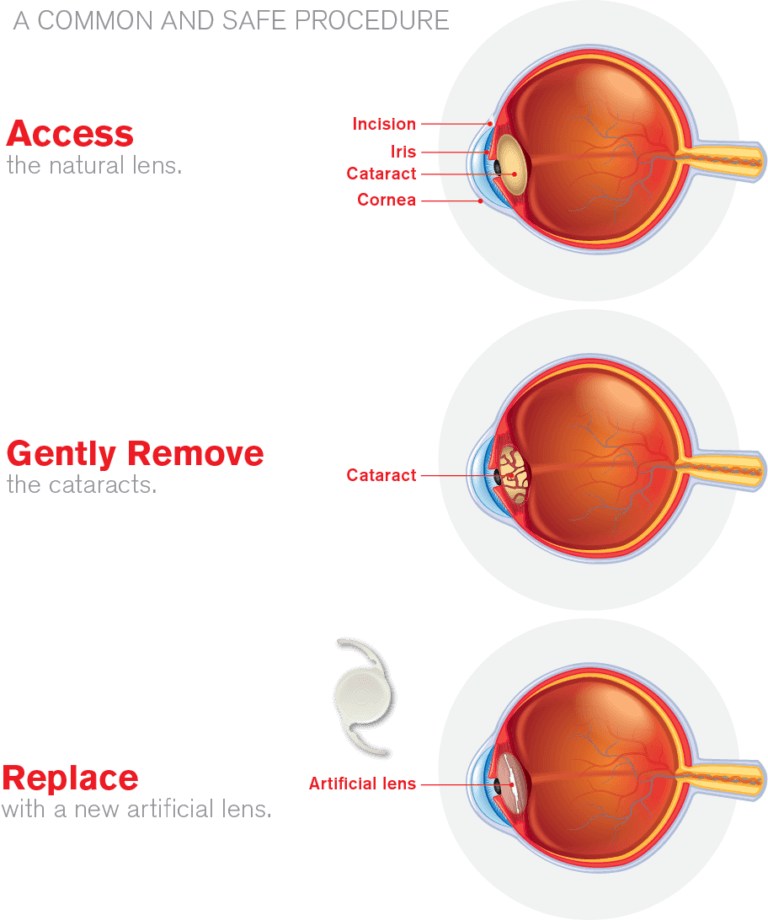 Cataract Surgery Short Hills Ophthalmology